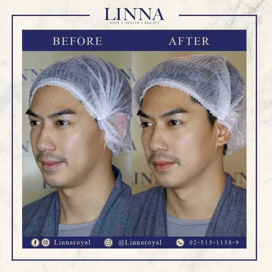 มาทำความเข้าใจ ระหว่าง Thermage กับ Ulthera กันเถอะ!