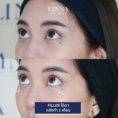 รีวิวฉีดฟิลเลอร์ใต้ตา Linna Clinic