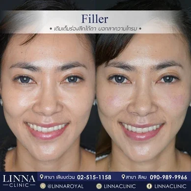 รีวิวฉีดฟิลเลอร์ใต้ตา Linna Clinic