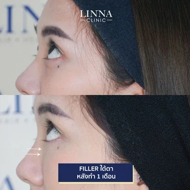 รีวิวฉีดฟิลเลอร์ใต้ตา Linna Clinic