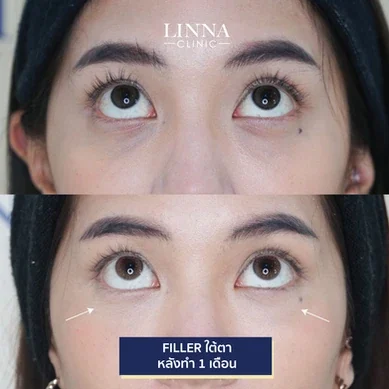 รีวิวฉีดฟิลเลอร์ใต้ตา Linna Clinic