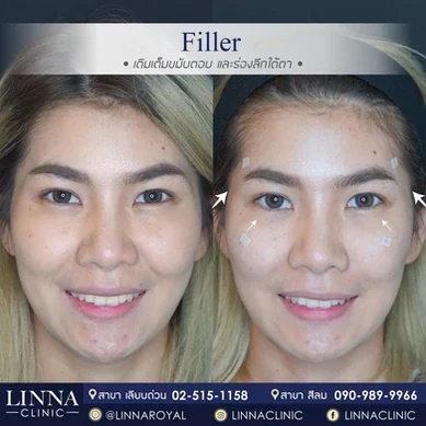รีวิวฉีดฟิลเลอร์ใต้ตา Linna Clinic