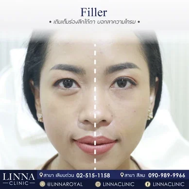 รีวิวฉีดฟิลเลอร์ใต้ตา Linna Clinic