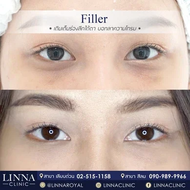 รีวิวฉีดฟิลเลอร์ใต้ตา Linna Clinic