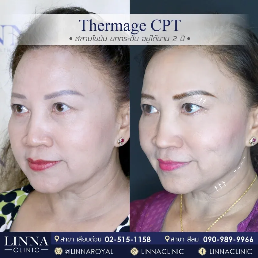 Thermage คืออะไร รวบรวมข้อควรรู้ก่อนทำ Thermage
