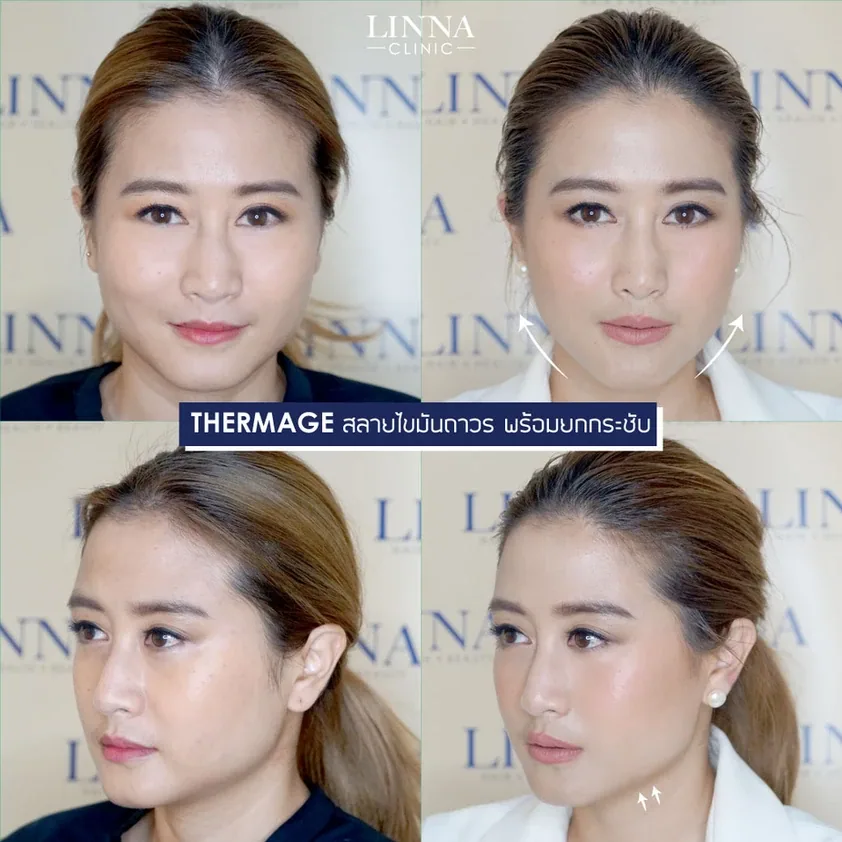 Thermage คืออะไร รวบรวมข้อควรรู้ก่อนทำ Thermage