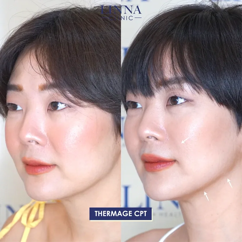 Thermage คืออะไร รวบรวมข้อควรรู้ก่อนทำ Thermage
