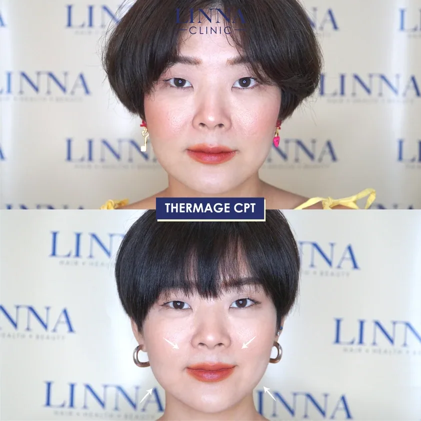 Thermage คืออะไร รวบรวมข้อควรรู้ก่อนทำ Thermage