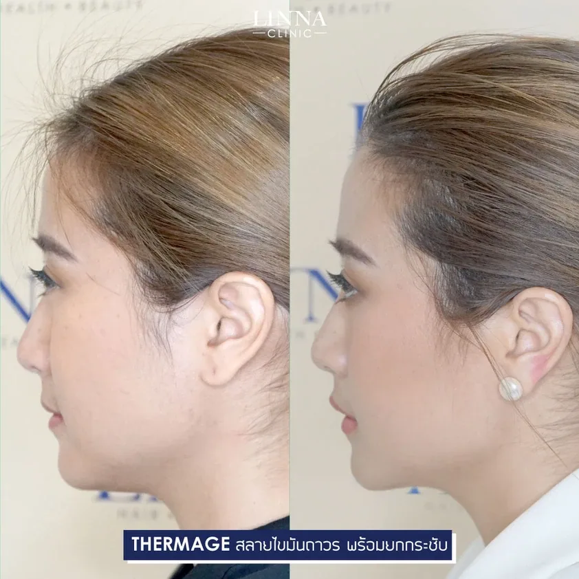 Thermage คืออะไร รวบรวมข้อควรรู้ก่อนทำ Thermage