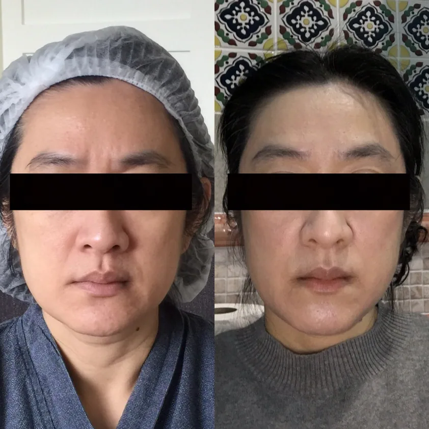Thermage คืออะไร รวบรวมข้อควรรู้ก่อนทำ Thermage