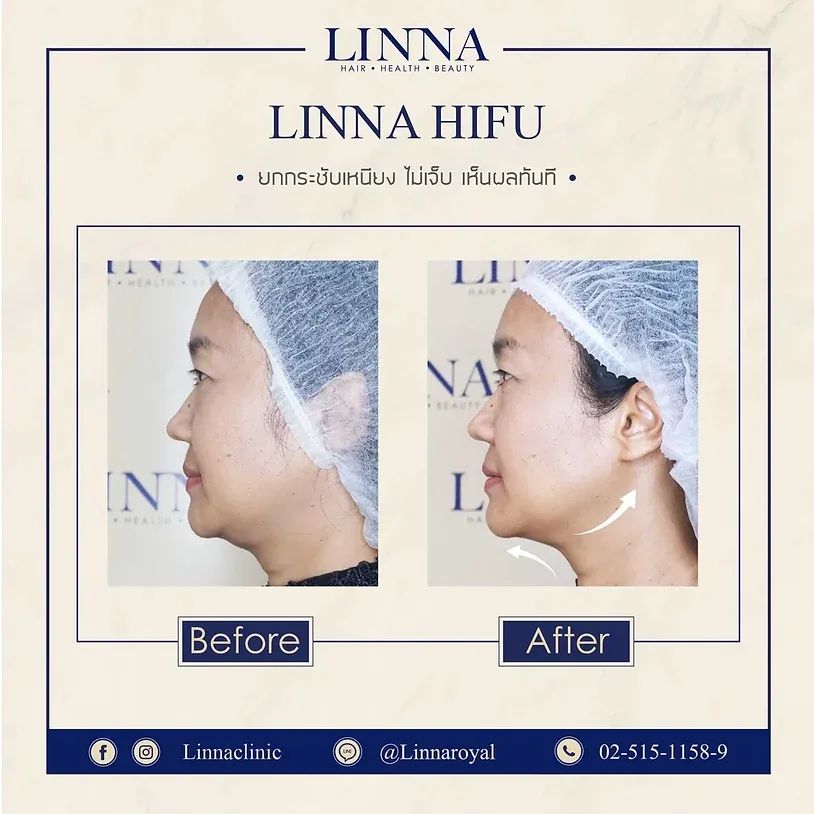 ทำ Hifu ที่ไหนดี