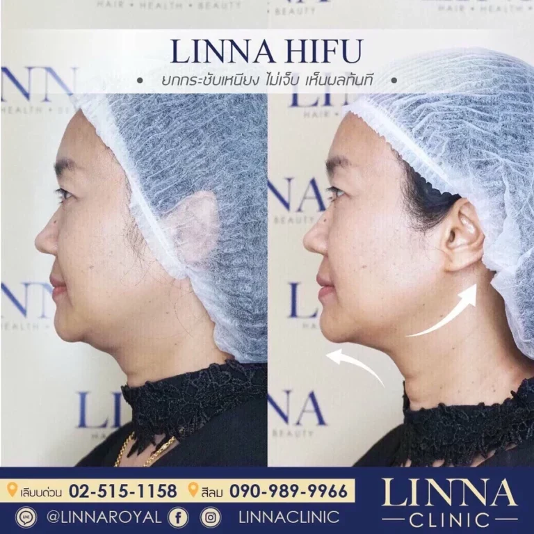 ทำไมทำ HIFU แล้วไม่เห็นผล มันเกิดจากอะไรกันแน่