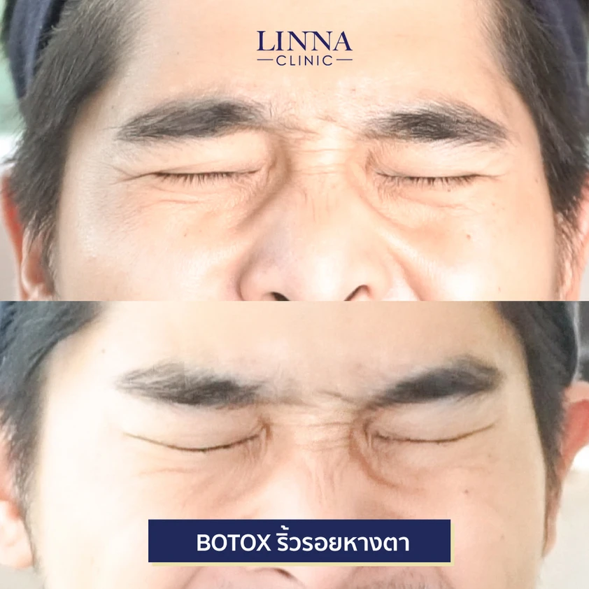 โปรแกรมโบ ดีจริงไหม รวม 9 ข้อควรรู้ก่อนทำโปรแกรมโบ