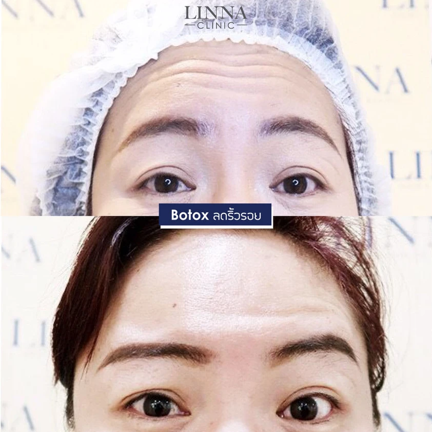 โปรแกรมโบ ดีจริงไหม รวม 9 ข้อควรรู้ก่อนทำโปรแกรมโบ