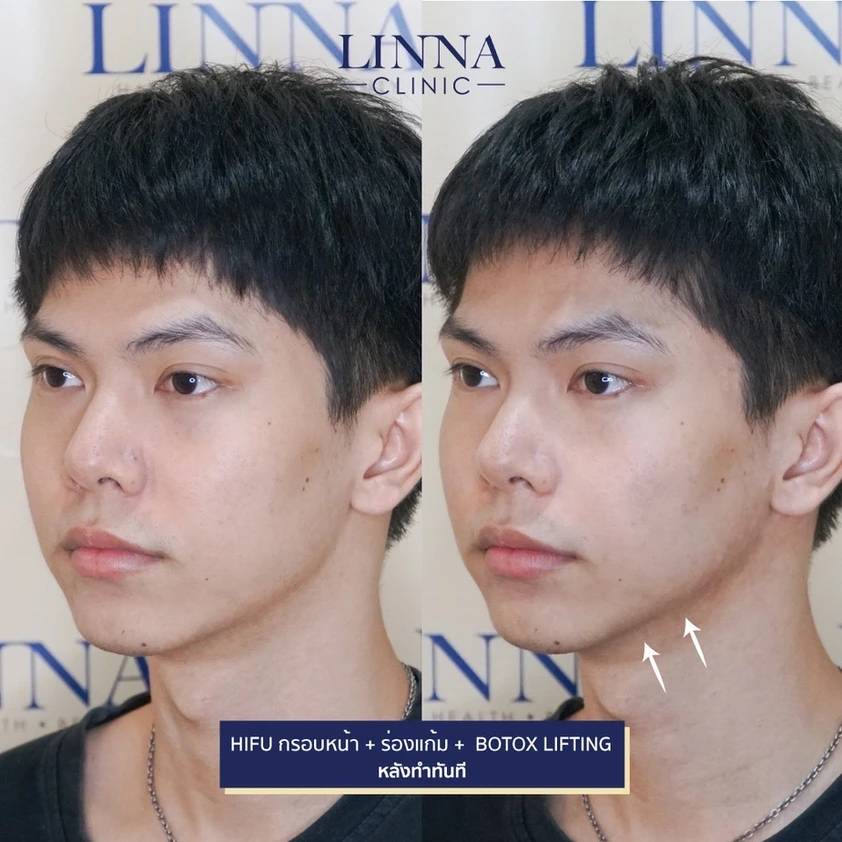 โปรแกรมโบ ดีจริงไหม รวม 9 ข้อควรรู้ก่อนทำโปรแกรมโบ