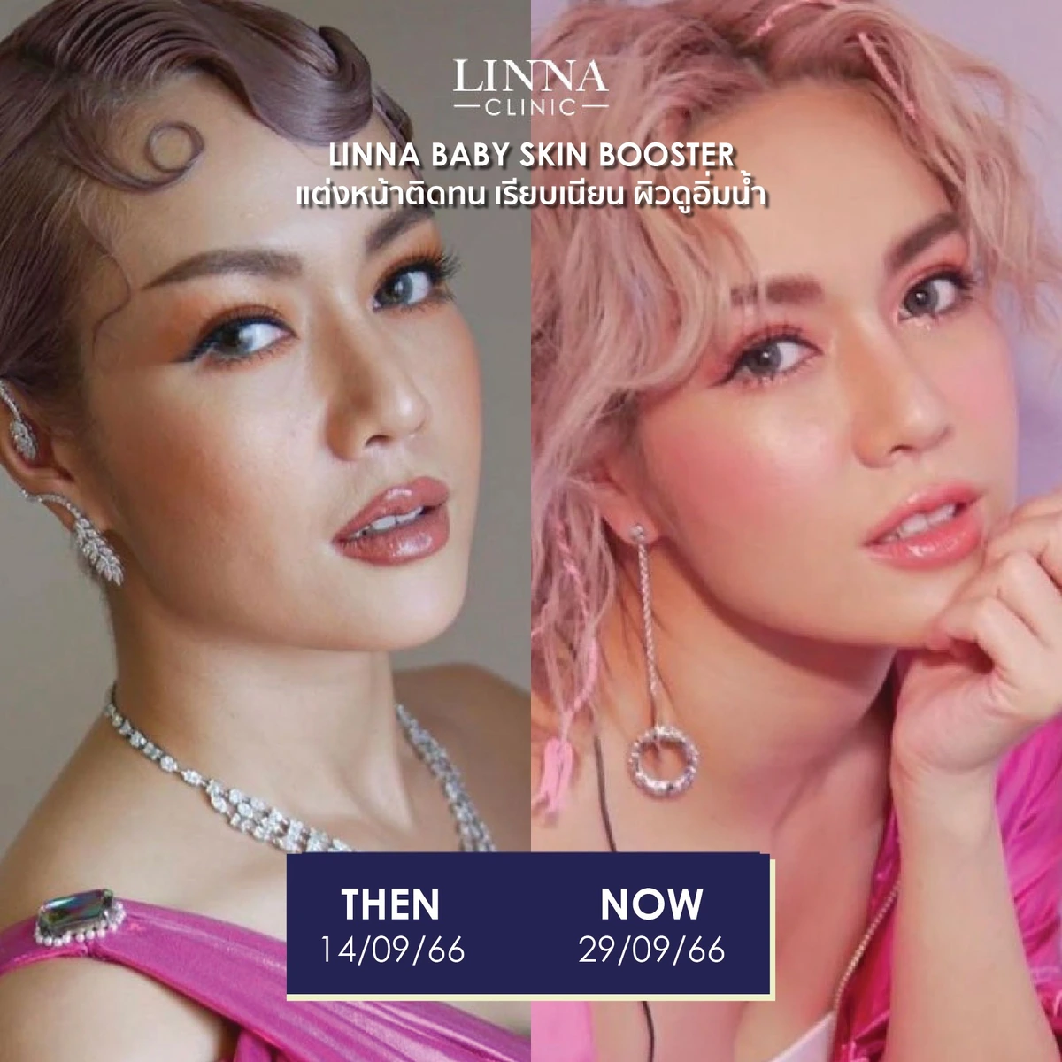 รีวิวก่อนและหลังทำ LINNA Baby Skin Booster