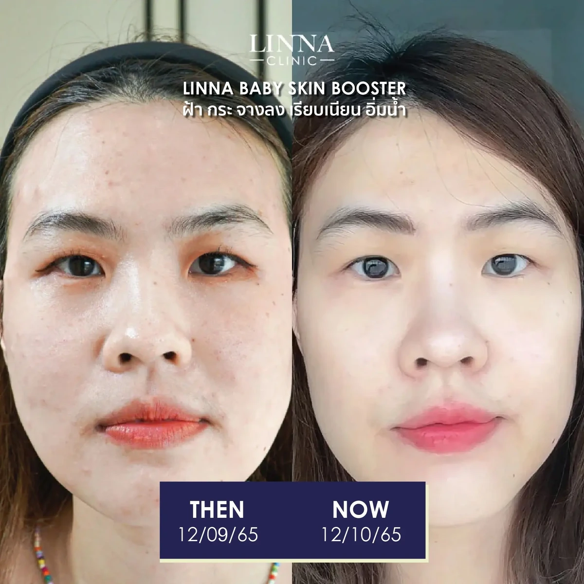 รีวิวก่อนและหลังทำ LINNA Baby Skin Booster