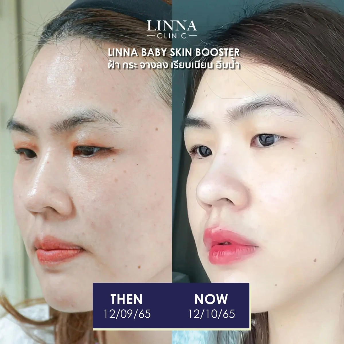 รีวิวก่อนและหลังทำ LINNA Baby Skin Booster