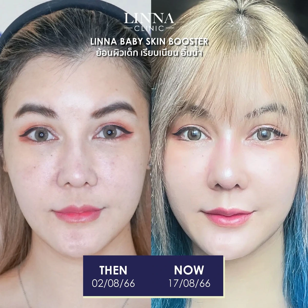รีวิวก่อนและหลังทำ LINNA Baby Skin Booster