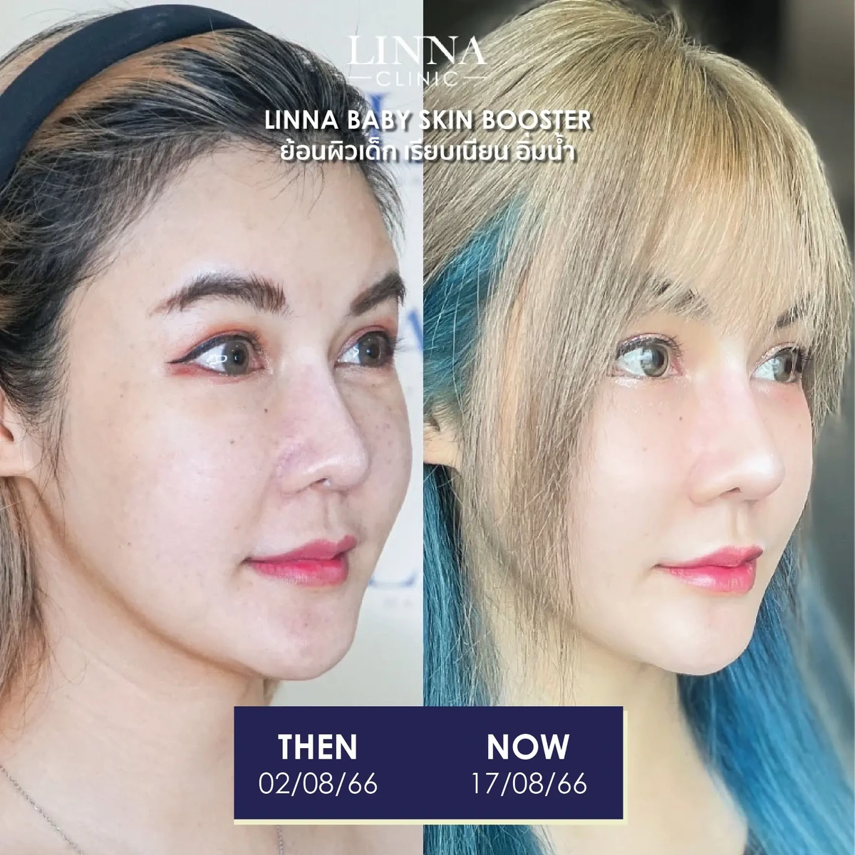 รีวิวก่อนและหลังทำ LINNA Baby Skin Booster