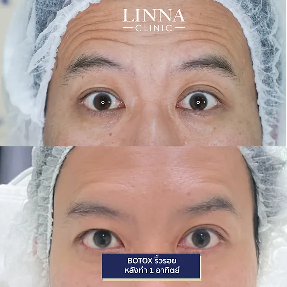 LINNA Clinic Bo ช่วยลดริ้วรอย ปรับรูปหน้าและรูปคิ้ว ไม่มีผลข้างเคียงและไม่ทิ้งสารตกค้างภายในร่างกาย