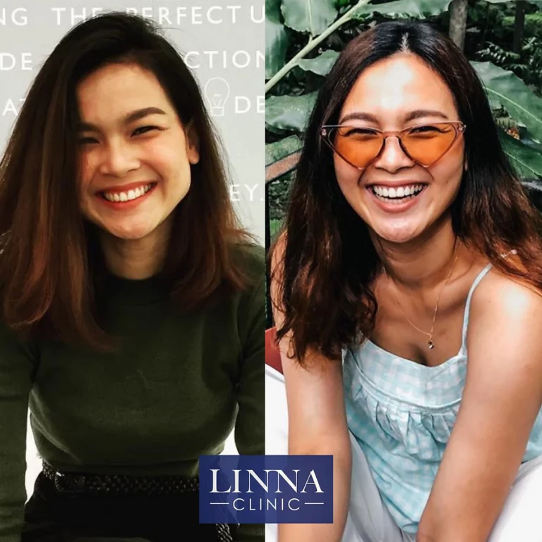 LINNA Clinic Bo ช่วยลดริ้วรอย ปรับรูปหน้าและรูปคิ้ว ไม่มีผลข้างเคียงและไม่ทิ้งสารตกค้างภายในร่างกาย
