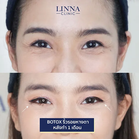 LINNA Clinic Bo ช่วยลดริ้วรอย ปรับรูปหน้าและรูปคิ้ว ไม่มีผลข้างเคียงและไม่ทิ้งสารตกค้างภายในร่างกายอ