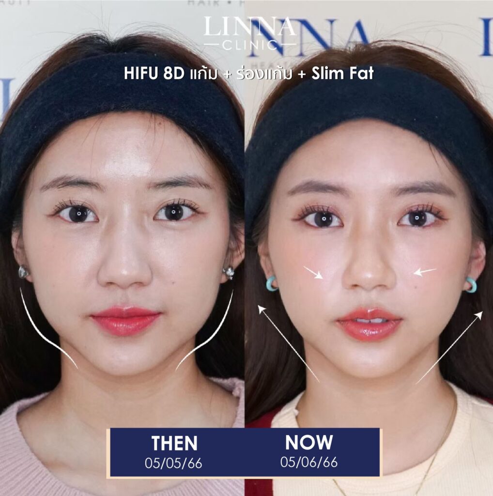 LINNA Clinic treatment result