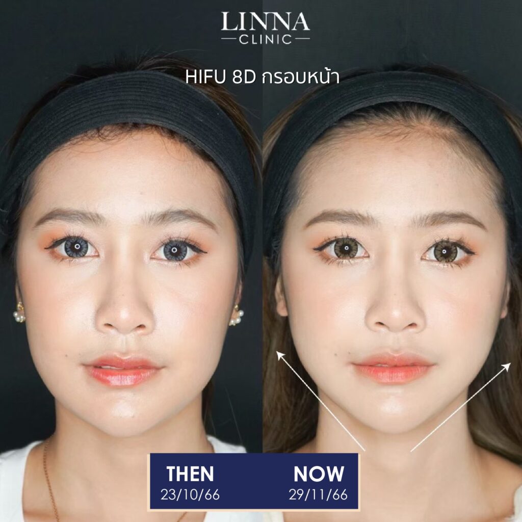LINNA Clinic treatment result