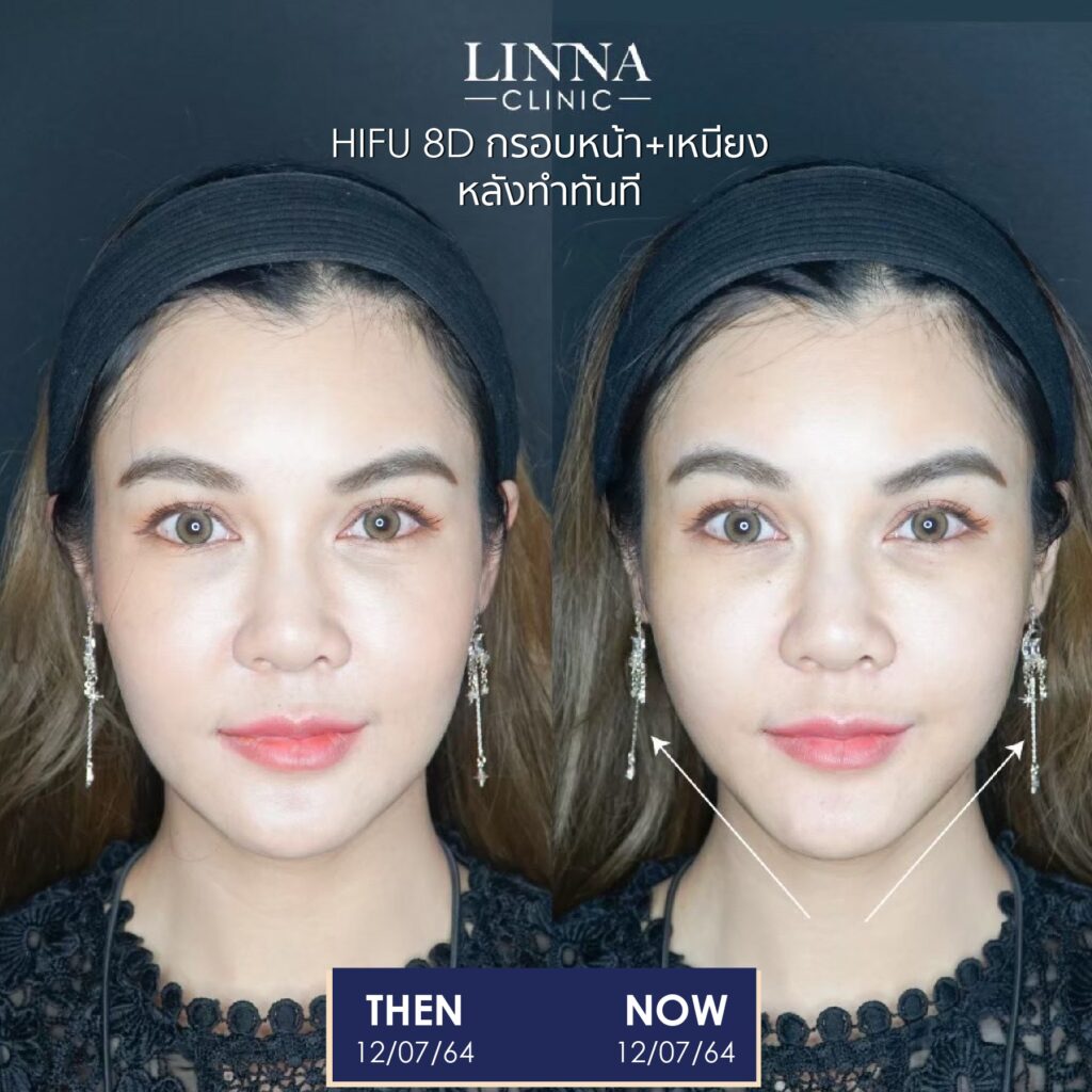 LINNA Clinic treatment result
