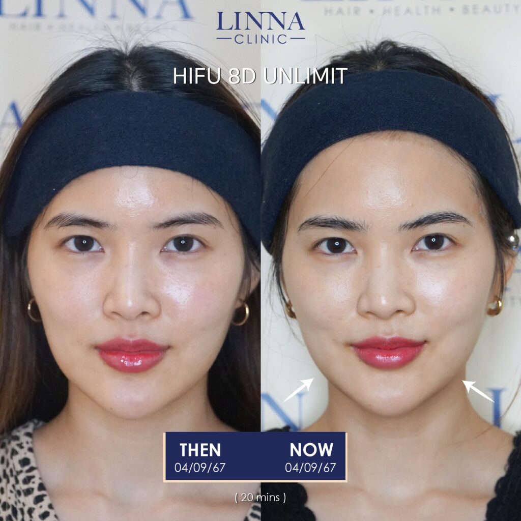 LINNA Clinic treatment result