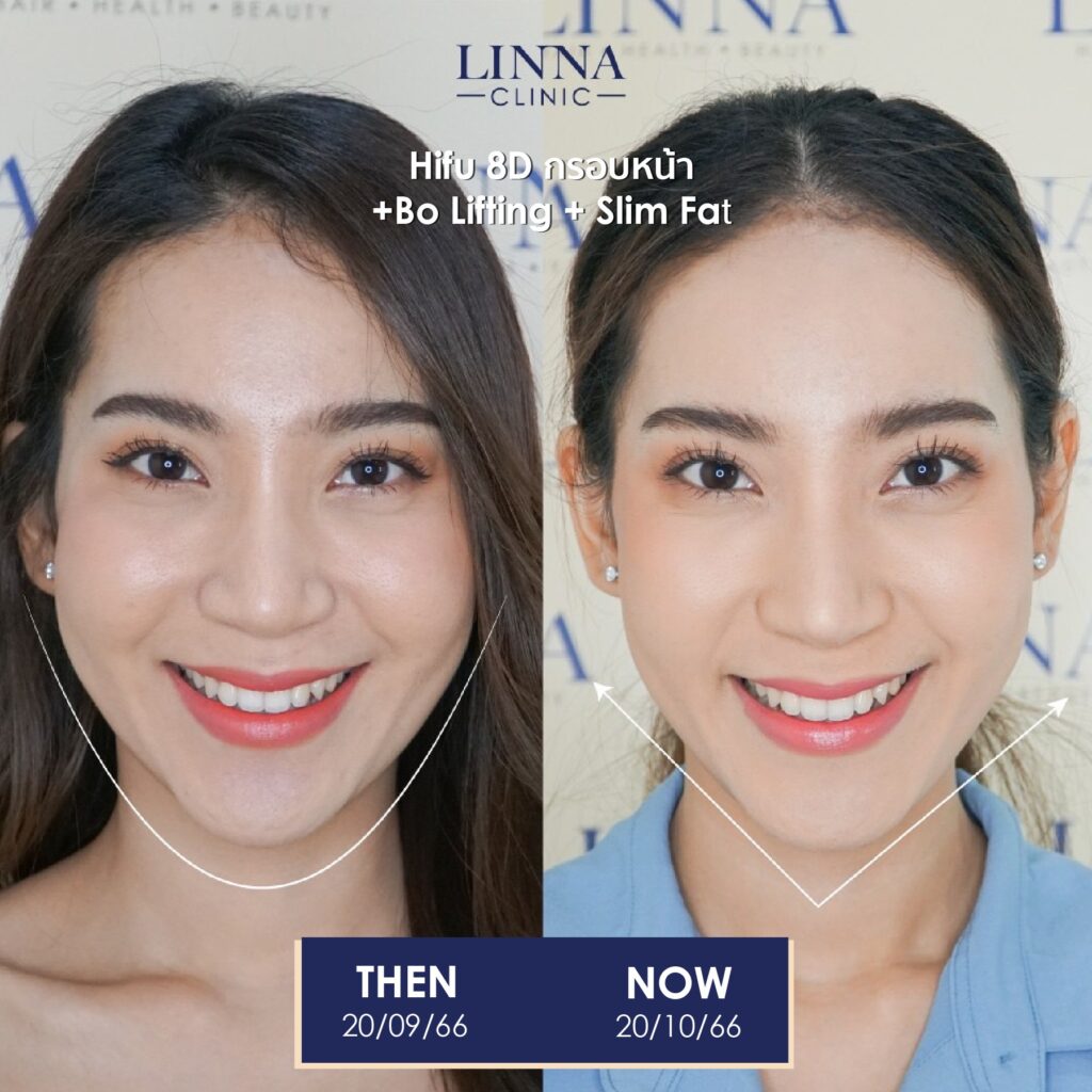 LINNA Clinic treatment result