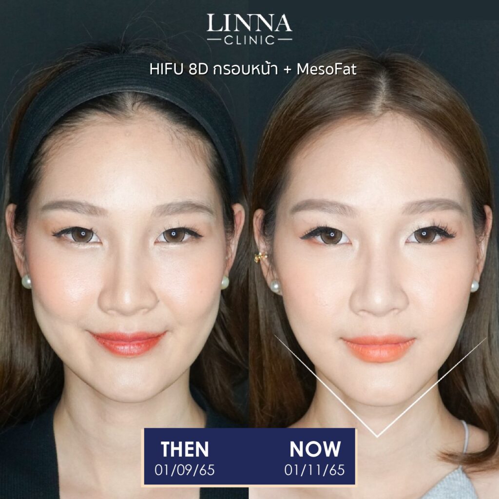 LINNA Clinic treatment result