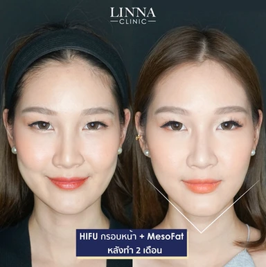 LINNA Clinic HIFU 8D คือนวัตกรรมการยกกระชับใบหน้าและร่างกายแบบไม่เจ็บจากเกาหลี