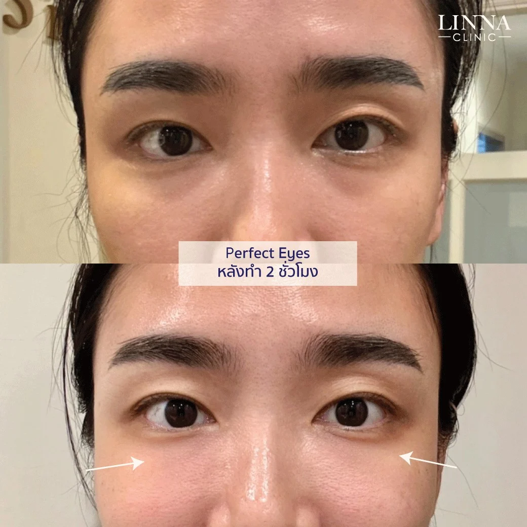 LINNA Perfect Eye before and after review 1