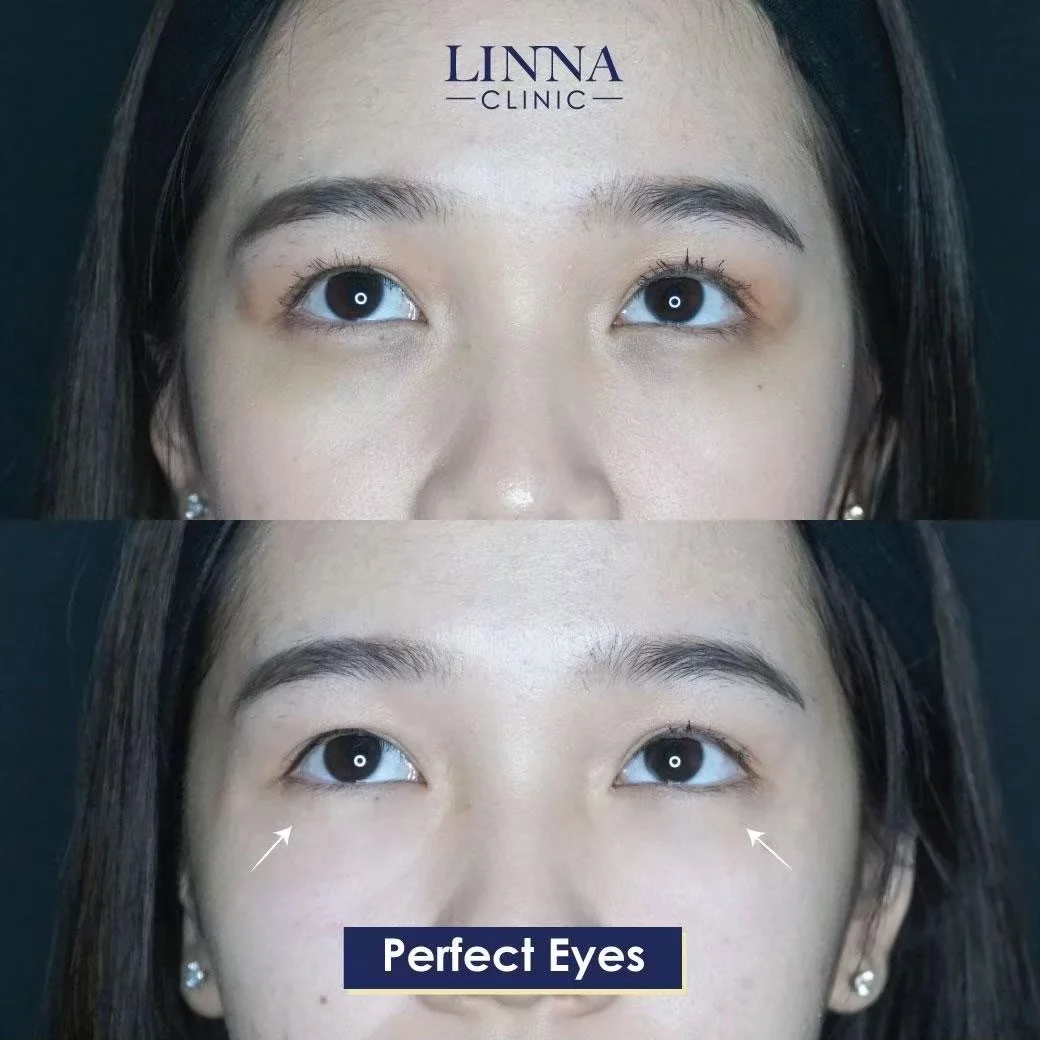 LINNA Perfect Eye before and after review 2