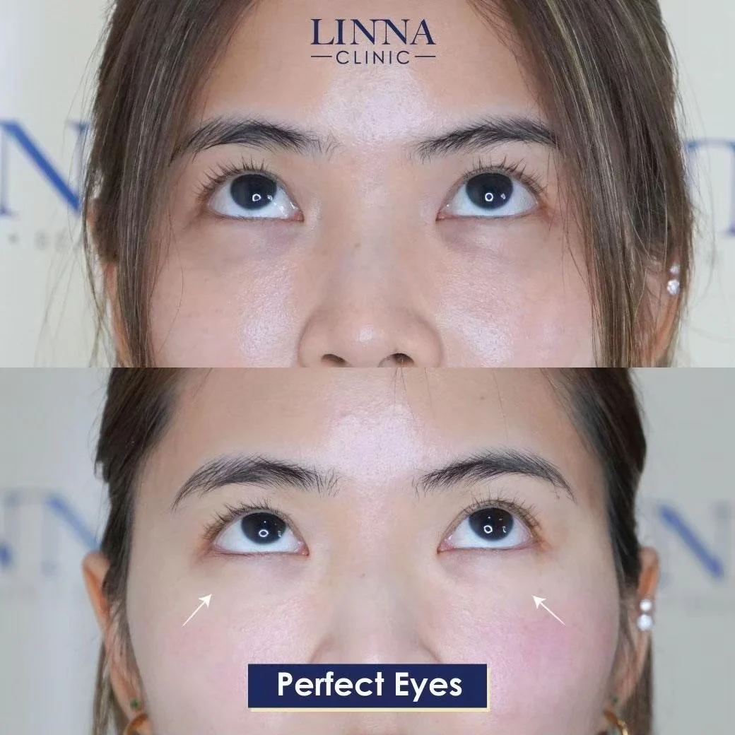 LINNA Perfect Eye before and after review 4