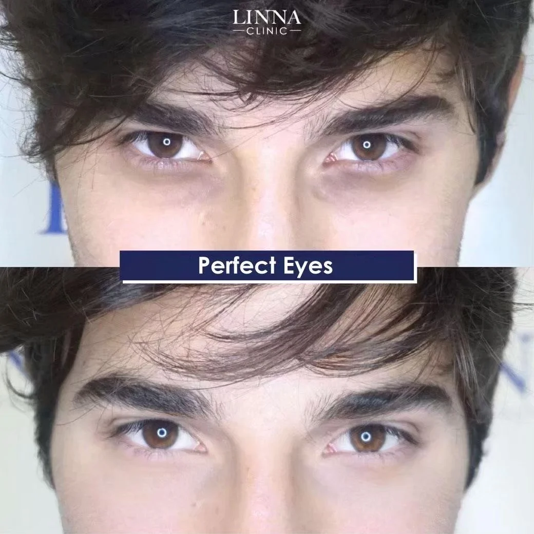 LINNA Perfect Eye before and after review 7