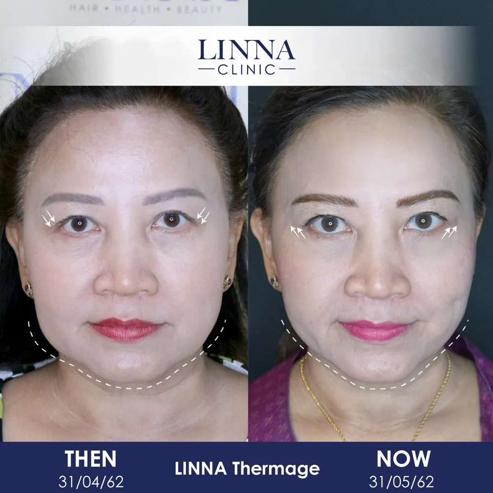 LINNA Thermage before and after - front view