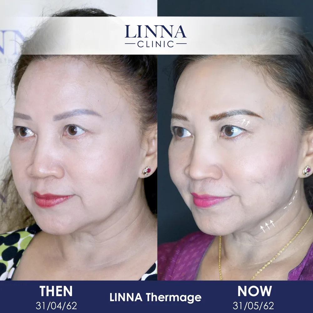 LINNA Thermage before and after - side view