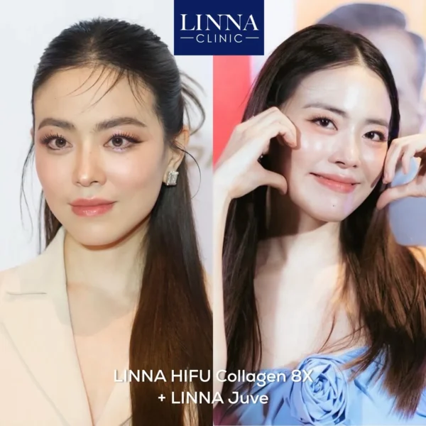 Juvelook collagen stimulator treatment before and after results at LINNA Clinic Bangkok