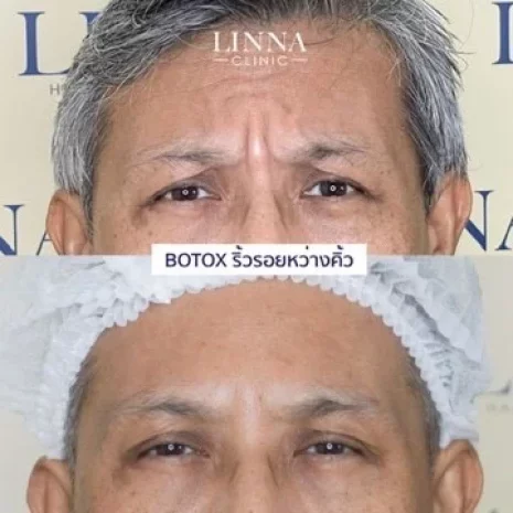 linna-review-botox-15.webp