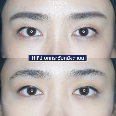 Review HIFU upper eyes
